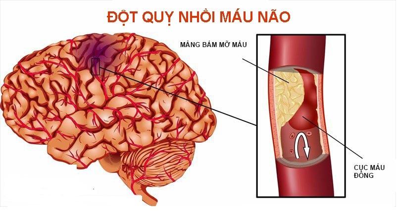 Dấu hiệu cảnh báo đột quỵ