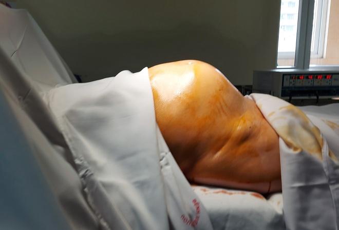 Người phụ nữ mang khối u to như thai nhi 7 tháng tuổi