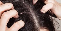 Bé gái 11 tuổi trúng độc vì mẹ dùng thuốc sâu diệt chấy cho con