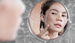 Top 5 cách trị nám nắng đơn giản mà hiệu quả ngay tại nhà bạn nên thử