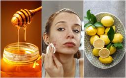 Bỏ túi ngay 7 cách trị mụn tại nhà nhanh nhất trong 1 ngày hiệu quả