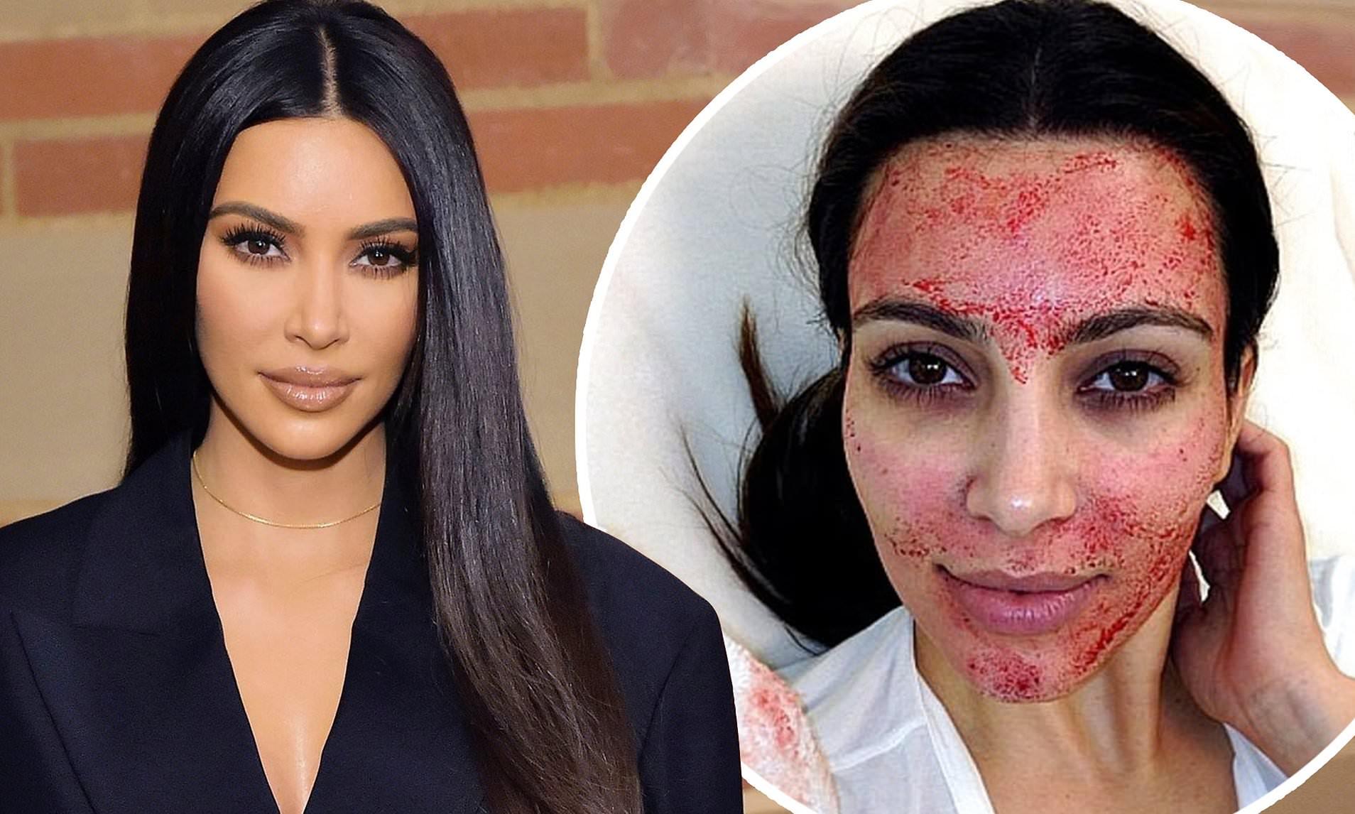 Kim Kardashian ước mình chưa bao giờ làm đẹp bằng máu