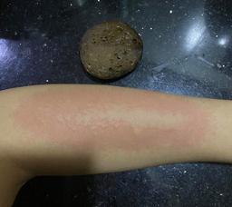 Cô gái bị dị ứng và bong da do tẩy da chết bằng đá