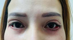 Cảnh báo: Cắt mí sai cách, đôi mắt của cô gái 25 tuổi trở nên vô cùng đáng sợ