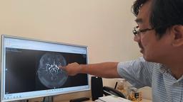 Bé 3 tuổi bị đột quỵ, bác sĩ chỉ ra nguyên nhân