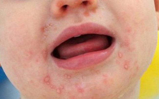 TPHCM: Bệnh chân tay miệng tăng vọt