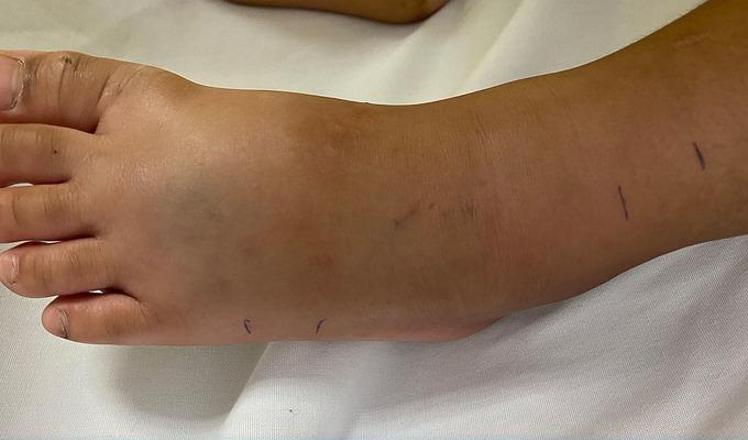 TP.HCM: Bé trai 4 tuổi bị rắn lục đuôi đỏ cắn