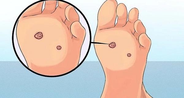 Dấu hiệu điển hình ở chân cảnh báo nguy cơ mắc ung thư cổ tử cung