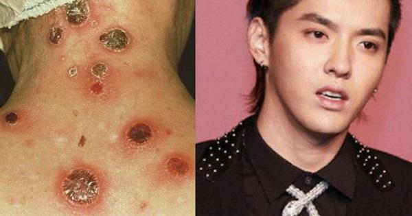 Bệnh giang mai mà Ngô Diệc Phàm bị đồn mắc phải nguy hiểm cỡ nào?