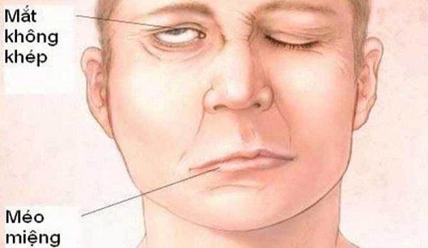 Liệt dây thần kinh số 7 mà Lou Hoàng mắc phải là bệnh gì, nguy hiểm ra sao?