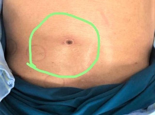 Hòa Bình: Người đàn ông bị suy đa tạng vì bị sốt mò