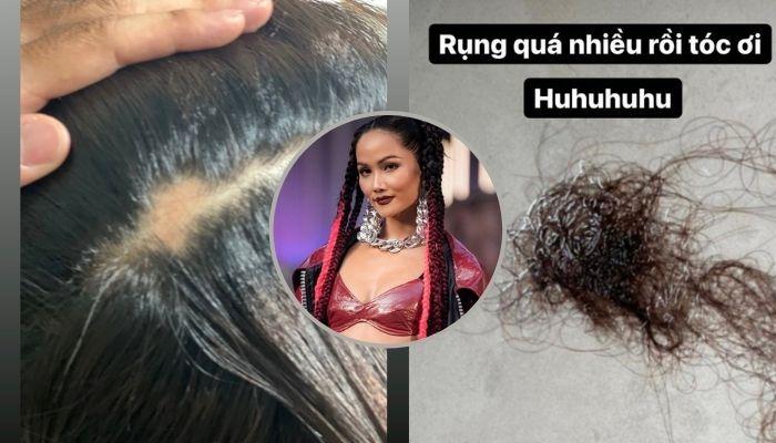 Top 5 Hoa hậu Hoàn vũ thế giới H'Hen Niê bị hói ở tuổi 30, khổ sở vì tóc rụng cả mảng