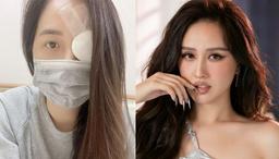 Fan lo lắng khi Mai Phương Thúy nhập viện với 1 bên mắt băng kín, hối hận vì tự chữa bệnh tại nhà