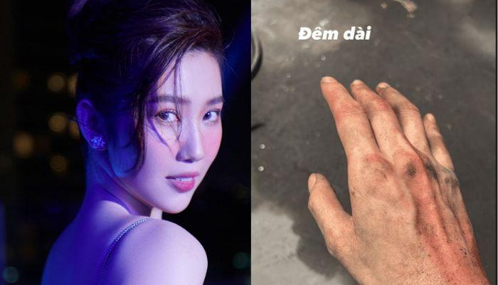 Thuý Ngân bất ngờ đăng ảnh tay bầm dập, nói 1 câu khiến fan lo lắng