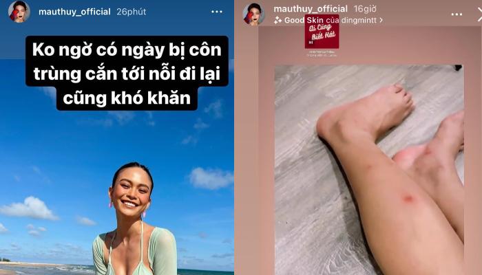 Đi nghỉ dưỡng sang chảnh, Mâu Thủy bị côn trùng cắn nổi “hoa” đầy chân, đi lại cũng khó khăn