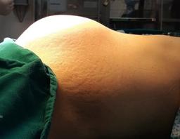 Hà Nội: Tưởng thai 9 tháng, hoá ra u xơ tử cung