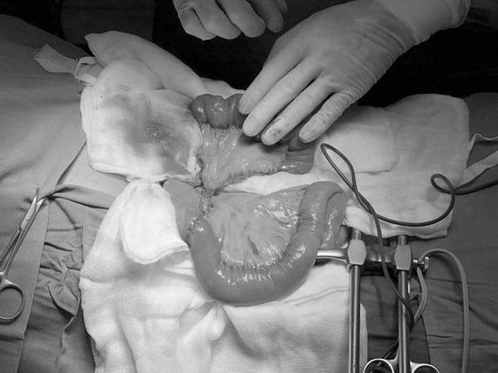 Lần đầu tiên ghép nối ruột tái tạo đường ăn cho bệnh nhân ung thư họng