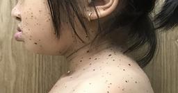 Việt Nam ghi nhận trường hợp đầu tiên mắc hội chứng da báo