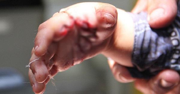 Bạc Liêu: Bé trai 34 tháng tuổi bị cá sấu tấn công