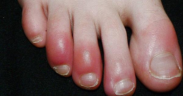 Chuyên gia y tế thế giới cảnh báo triệu chứng mới của người nhiễm Covid-19