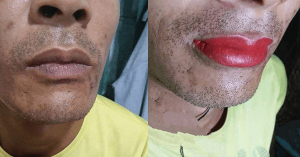 Ông bố nghe lời hàng xóm đi khử môi thâm và kết quả