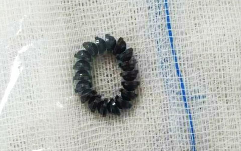 TP.HCM: Bé trai 3 tuổi phải nối ruột do nuốt 18 viên nam châm