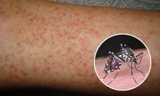 Cách phân biệt Covid-19 và sốt xuất huyết