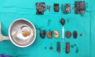 Hà Nội: Tìm thấy nhiều dị vật trong dạ dày bệnh nhân