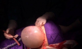 Hi hữu một bé trong ca song sinh chào đời còn nguyên bọc ối