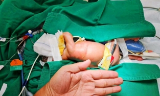 Phẫu thuật cho bé gái sinh non đa dị tật khi mới 2 ngày tuổi