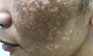 Một phụ nữ mất nửa tỷ chữa nám má, nhận lại khuôn mặt đầy sẹo và nám