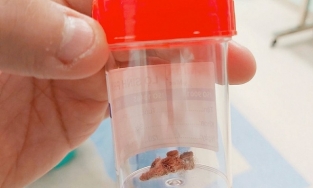 Miếng bông gòn kẹt trong âm đạo bé 6 tuổi