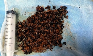 Người phụ nữ có lá gan chứa hàng trăm viên sỏi