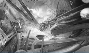 Người đàn ông nghĩ mình say cà phê không ngờ bị khối u trong tim 