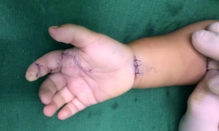 Bé 1 tuổi phải phẫu thuật nối gân vì cầm phải sâu róm