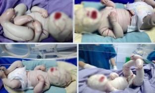 Bé bị da vảy cá bẩm sinh ở Hà Giang có tình trạng rất nặng