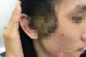 BV Da liễu TP.HCM ghi nhận số ca lây qua đường tình dục tăng cao