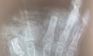 Mày mò chế tạo theo youtuber, nam sinh cụt 3 ngón tay vì quả pin phát nổ