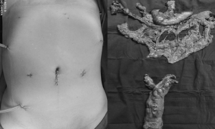 Hiếm gặp: Người đàn ông ở Thái Bình cùng lúc mắc 2 loại ung thư hàng đầu