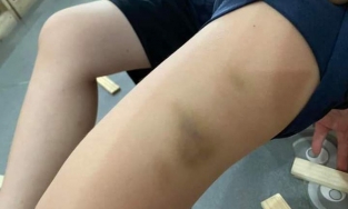 Huế: Phụ huynh tố cô giáo đánh học sinh lớp 1 bầm tím người