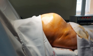 Người phụ nữ mang khối u to như thai nhi 7 tháng tuổi