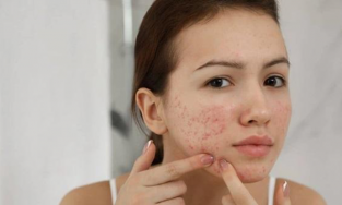 Mụn tuổi dậy thì có hết không?