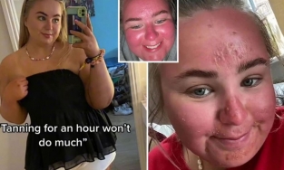 Sự thật về cô gái phơi nắng một giờ, gương mặt lập tức to lên gấp đôi