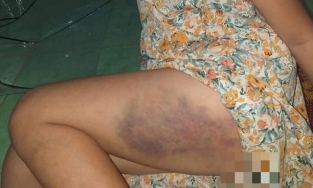 Quên mang bảng con đến lớp, học sinh lớp 3 bị cô giáo đánh bầm tím đùi