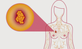 Lạng Sơn: Ngực cô gái 29 tuổi dài quá cạp quần vì khối u mọc chi chít