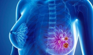 Kết hợp vaccine và thuốc miễn dịch để chống ung thư vú 