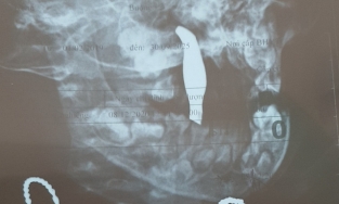 Bé trai 1 tuổi bị cây nhíp dài 10 cm đâm thủng từ miệng lên mũi