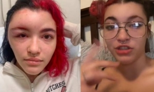 Cô gái tự nhuộm tóc khiến gương mặt biến dạng, sưng húp: Nên làm gì để không đi vào vết xe đổ?