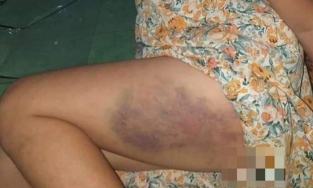 Giáo viên đánh bầm đùi học sinh bị phạt 3,75 triệu đồng, đình chỉ 3 tháng