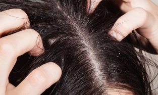 Bé gái 11 tuổi trúng độc vì mẹ dùng thuốc sâu diệt chấy cho con